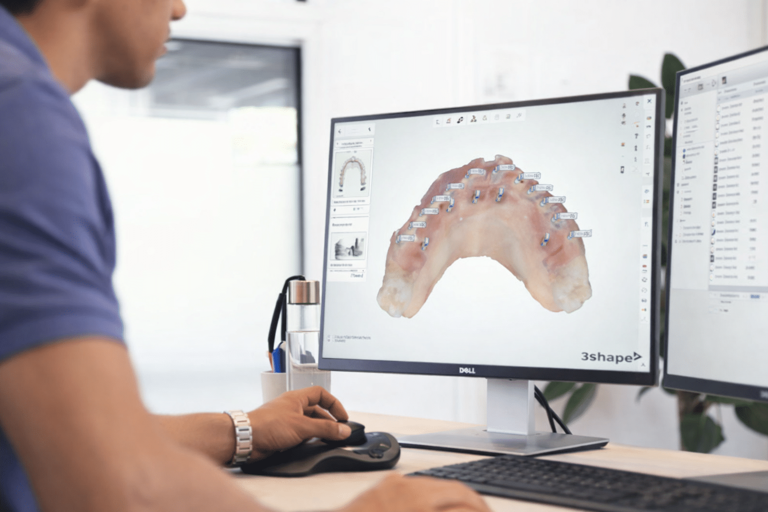 Workflow aligneurs pour dentistes